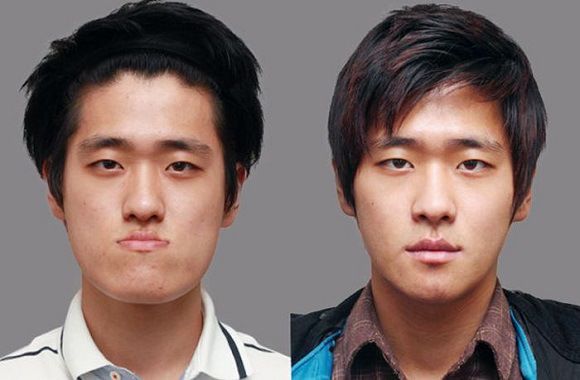 Foto operasi plastik korea 7