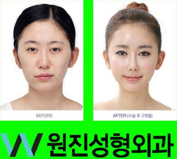 Foto operasi plastik korea 8