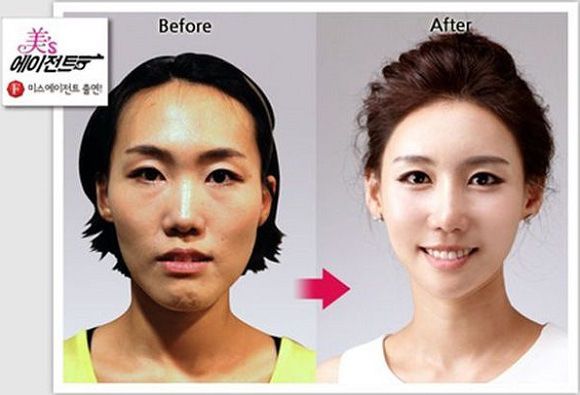 Foto operasi plastik korea 9